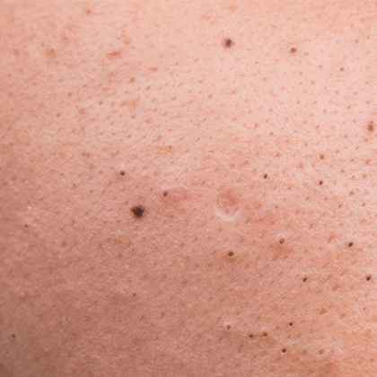 Blackheads and Sebaceous Filaments No More: Ultimate Guide to Clear